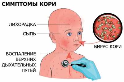 В каком регионе России злобствует корь